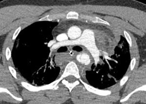 aorta chest trau